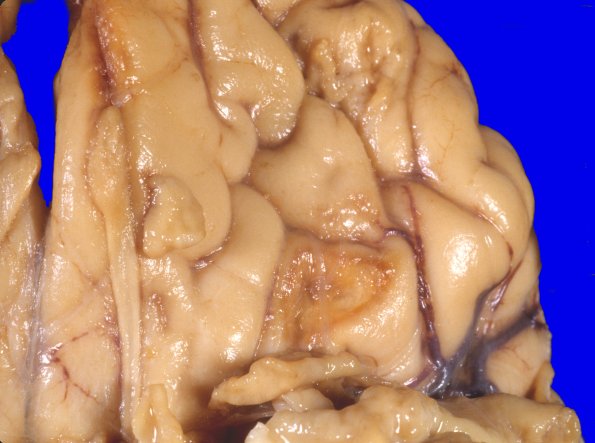 15A2 Contusion, chronic Sz Dz (Case 15) 2