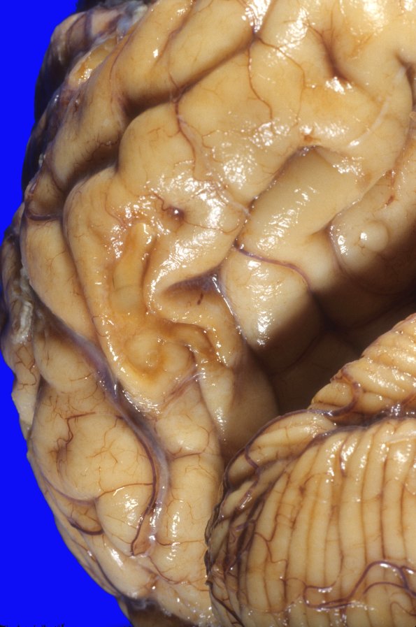 15A3 Contusion, chronic SZ Dz (Case 15) 3 A