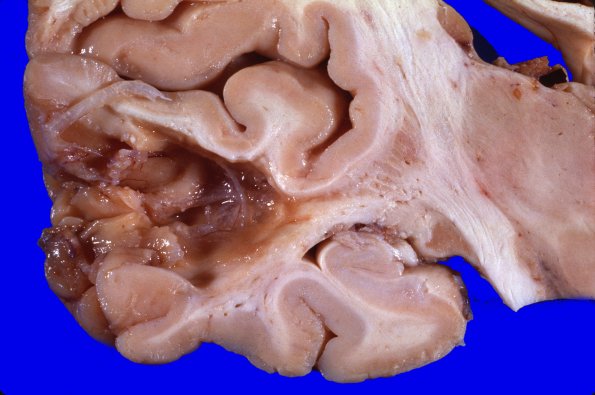 16A1 (Case 16) Contusion