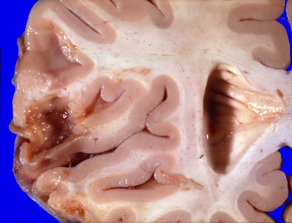 16A2 (Case 16) Contusion 3