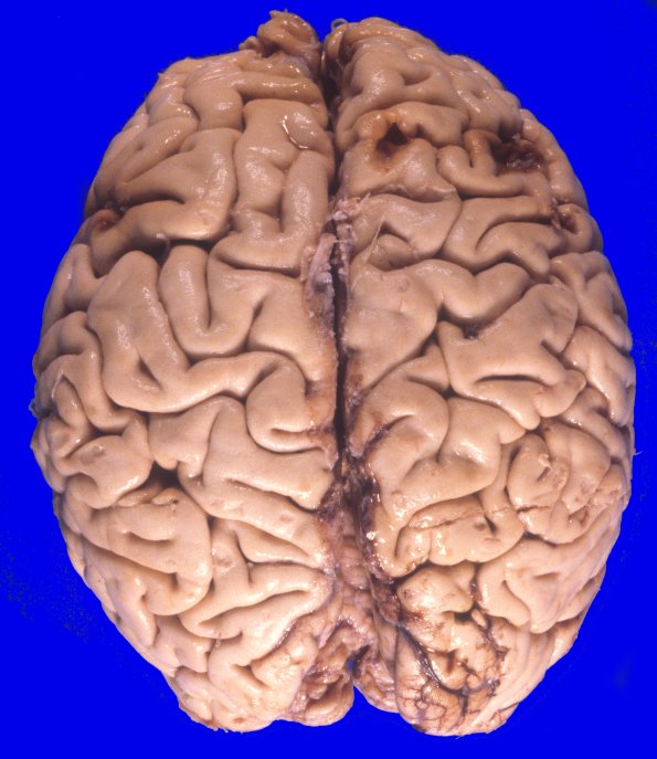 17A1 Trauma, Baseball bat (Case 17) 2