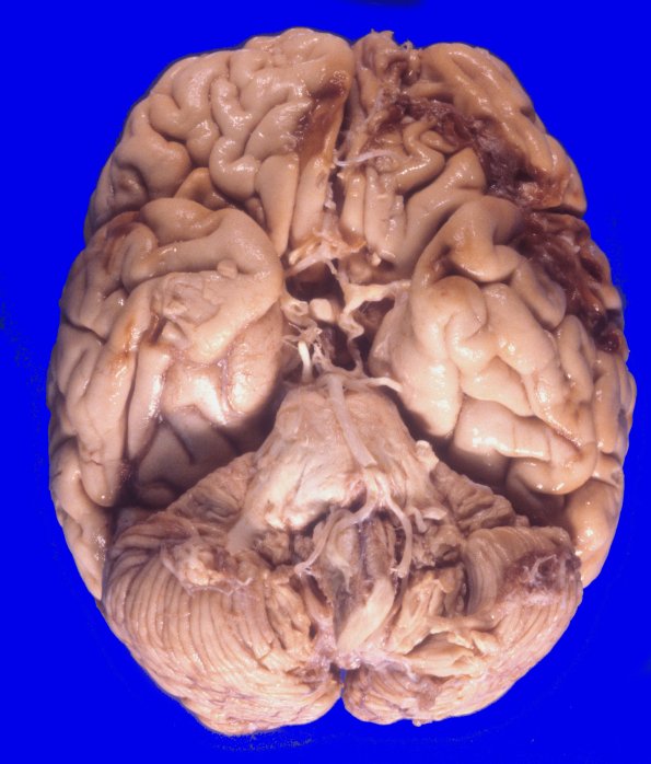 17A2 Trauma, Baseball bat (Case 17) 1