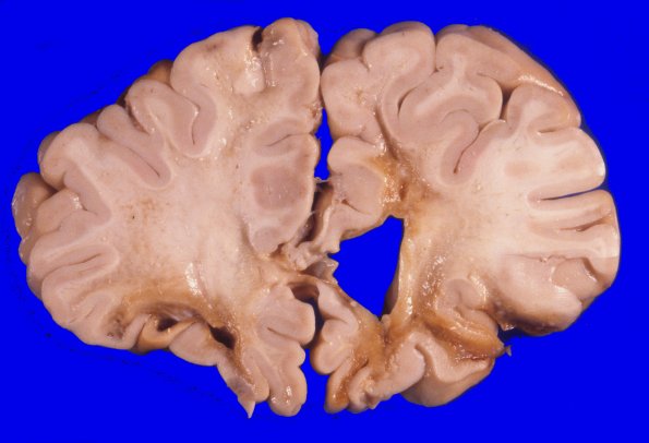 17A3 Trauma, Baseball bat (Case 17) 4