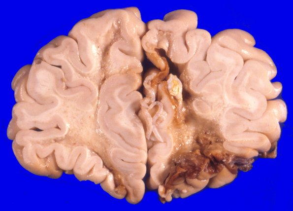 17A4 Trauma, Baseball bat (Case 17) 3