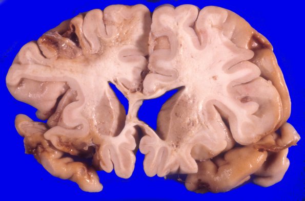 17A5 Trauma, Baseball bat (Case 17) 7