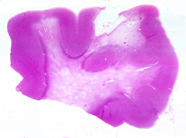 17B2 (Case 17) Contusion 1