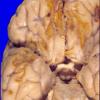 18A2 Contusions, no Trauma Hx, HIV-Encephalitis (Case 18) 3