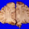 18A3 Contusions, no Trauma Hx, HIV-Encephalitis (Case 18) 1