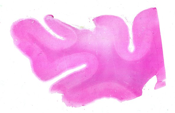 19A1 (Case 19) Contusion 1A