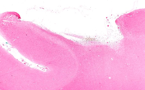 19A2 (Case 19) Contusion 2X