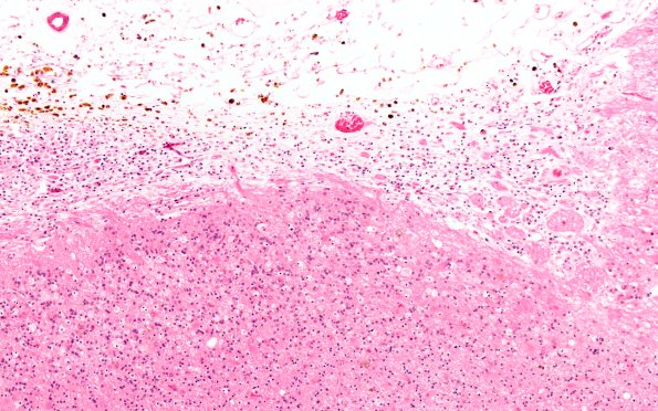 19A3 (Case 19) Contusion 10X