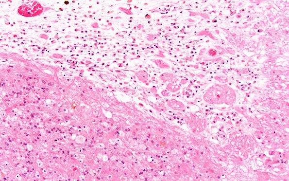 19A4 (Case 19) Contusion 20X