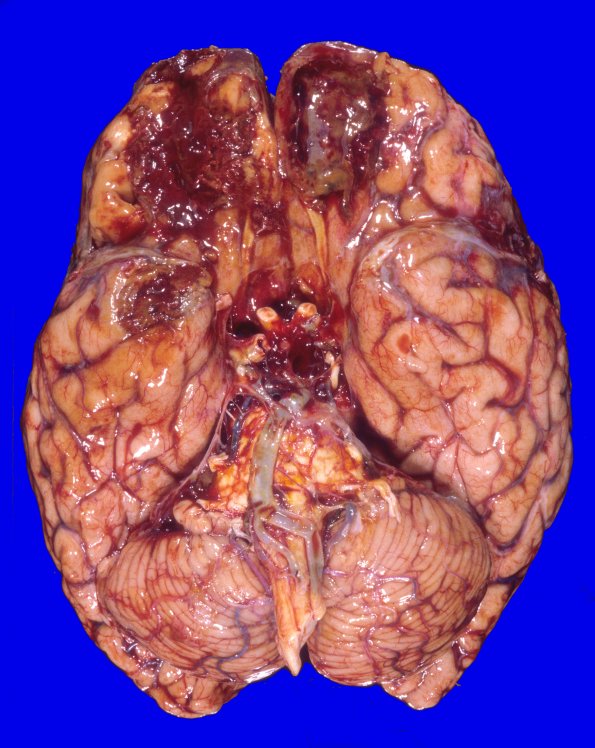 1A2 Contusion, 1 mo & remote Hx (Case 1) 2