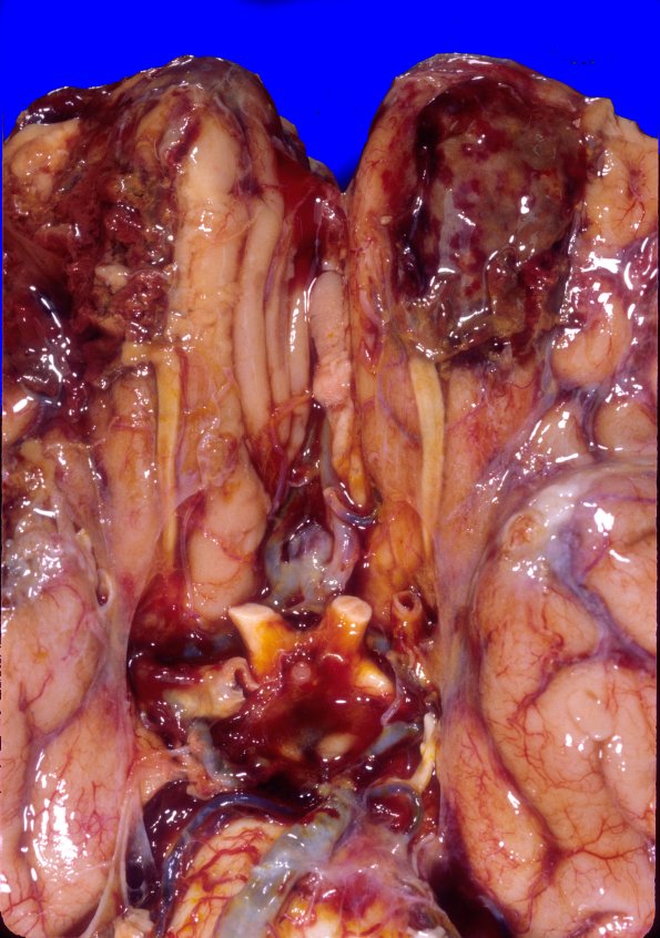 1A3 Contusion, 1 mo & remote Hx (Case 1) 3