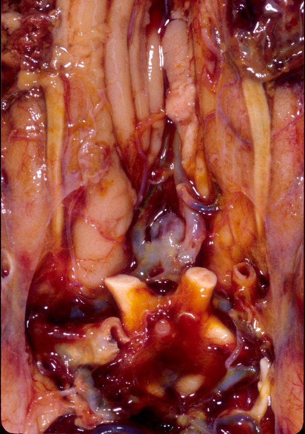 1A4 Contusion, 1 mo & remote Hx (Case 1) 4