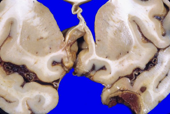 1A9 Contusion, 1 mo Hx (Case 1) 8