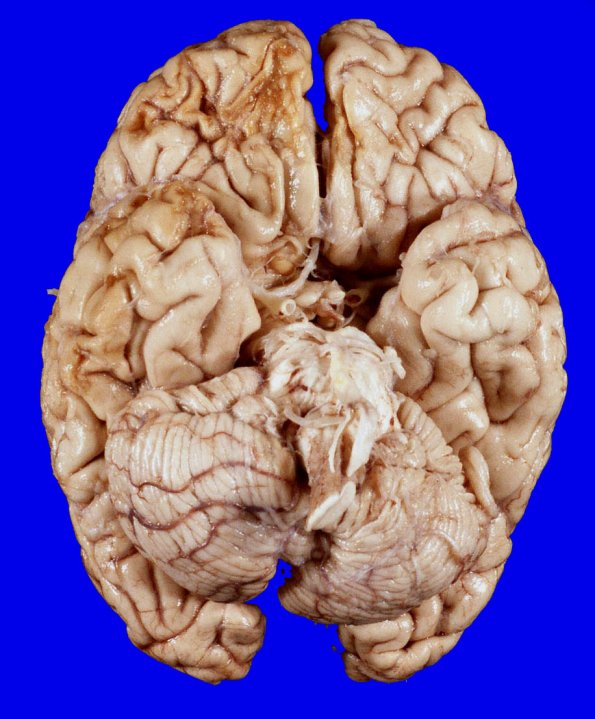 20A1 Contusions (Hx EtoH, NOS Case 20) 1