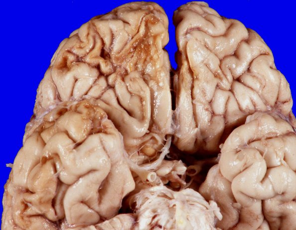 20A2 Contusions (Hx EtoH, NOS Case 20) 2