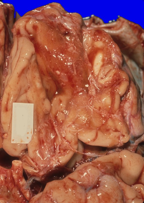 21A2 Contusions, subacute, trauma no Hx (Case 21) 2