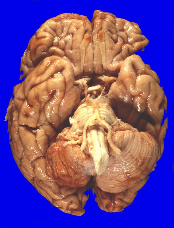 25A1 Contusion (Case 25) a