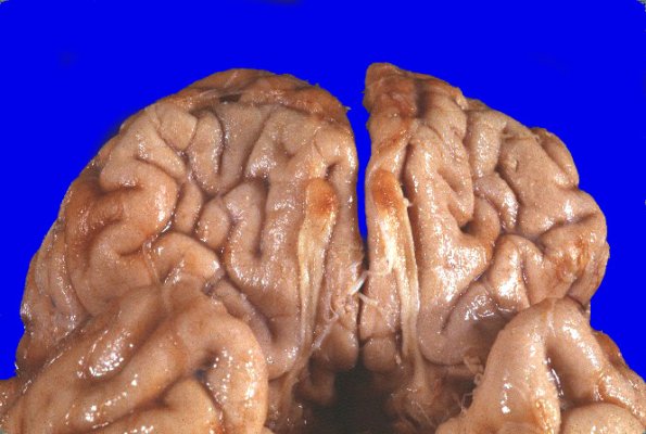 25A2 Encephalocoele (Case 25) 2