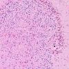 25B4-Trauma-Superficial-Siderosis-Case-25-N11-R-side-H-E-4.jpg