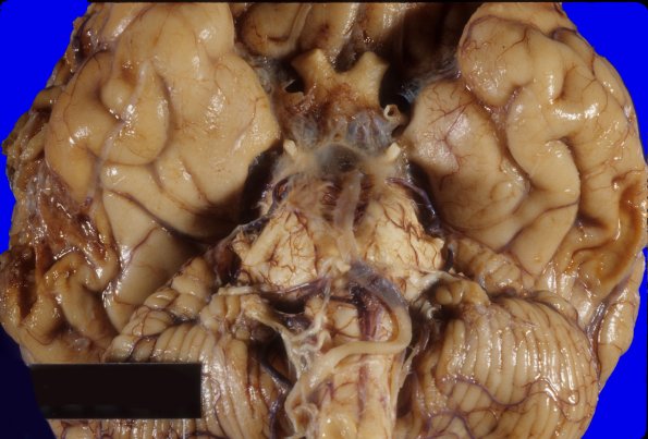26 Contusion, no Traumatic Hx (Case 26)