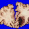 2A9 Trauma, contusion, SAH, SDH, fall, AD changes (Case 2)_9