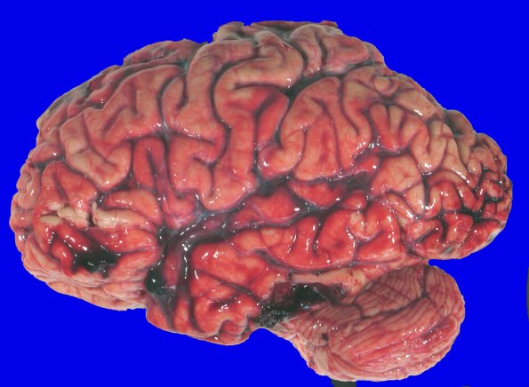 3A3 Contusion & SDH (fall on stairs, Case 3) 4