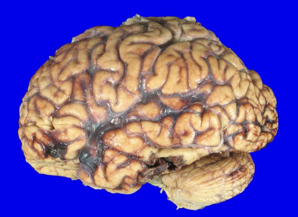 3A4 Contusion & SDH (fall on stairs, Case 3) 2