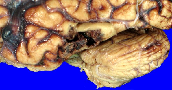 3A5 Contusion & SDH (fall on stairs, Case 3) 3