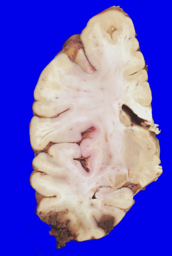 3A6 Contusion & SDH (fall on stairs, Case 3) 5