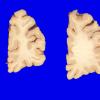 7A7 Contusions, subacute (Hx fall with SDH, Case 7) 4