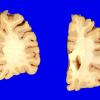 7A8 Contusions, subacute (Hx fall with SDH, Case 7) 5