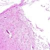 7B3 Contusions, subacute (Hx fall with SDH, Case 7) L23 H&E 10X