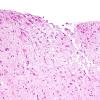 7E2 Contusions, subacute (Hx fall with SDH, Case 7) L21 H&E 20X