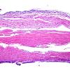 7H1 Contusions, subacute (Hx fall with SDH, Case 7) H&E 2