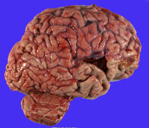 8A1 Contusion, remote (PD, Case 8) 1