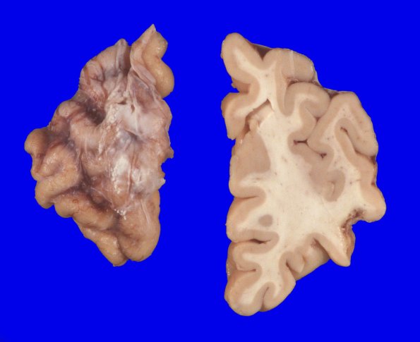 8A3 Contusion, remote (PD, Case 8) 3