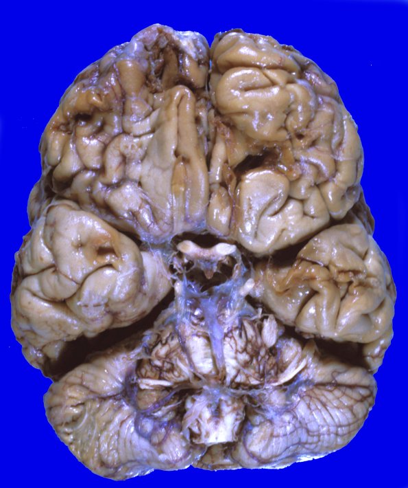 9A1 Contusion, remote (No ID) 1