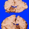 10 AVM (Case 10) basal ganglia 2