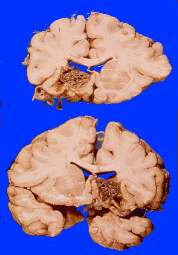 10 AVM (Case 10) basal ganglia 2