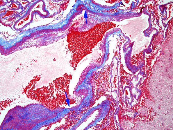 13A1 AVM (hybrid vessels, Case 13) Trichrome 2 copy