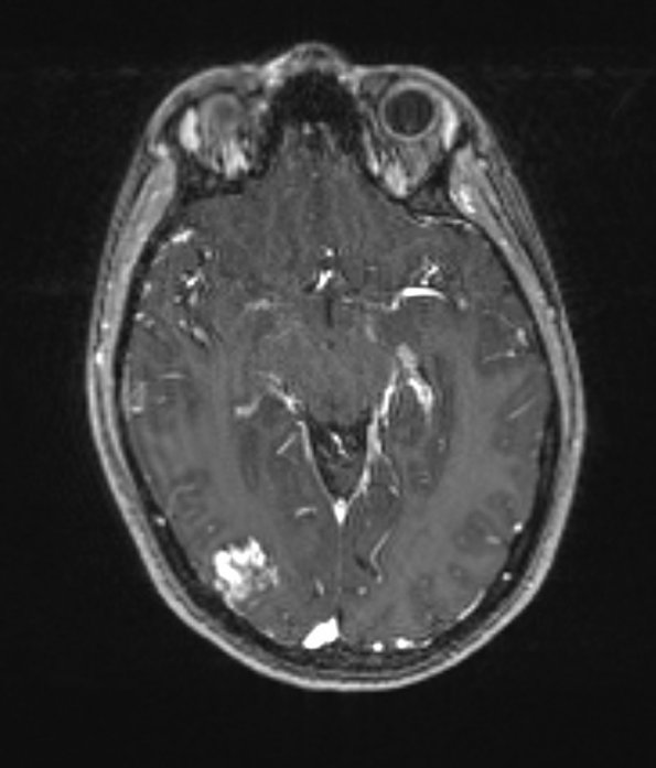 14A1 AVM (Case 14) stealth with contrast 1 - Copy