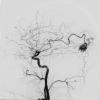 14A2 AVM (Case 14) Angiogram 1 - Copy