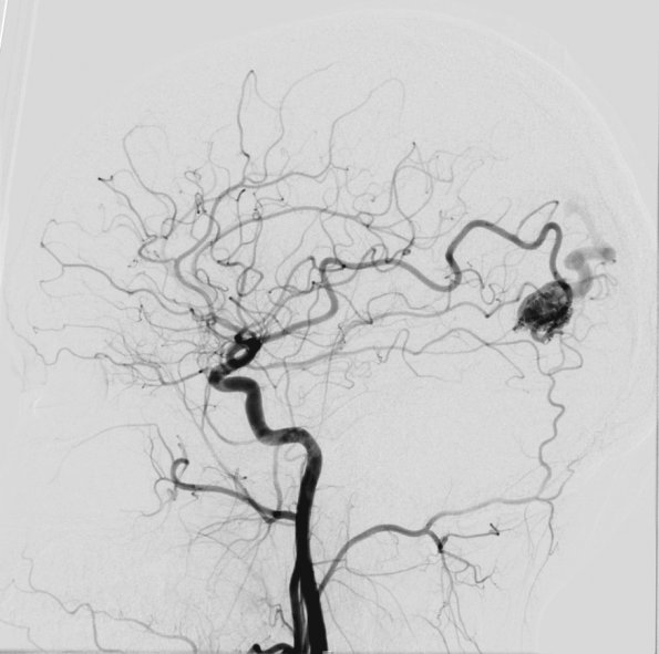 14A2 AVM (Case 14) Angiogram 1 - Copy