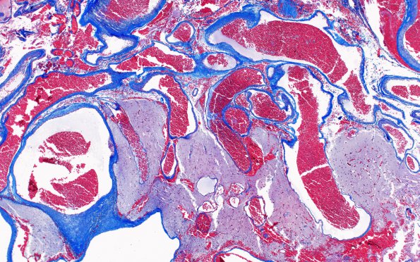 14C1 AVM (Case 14) Trichrome 2X 2