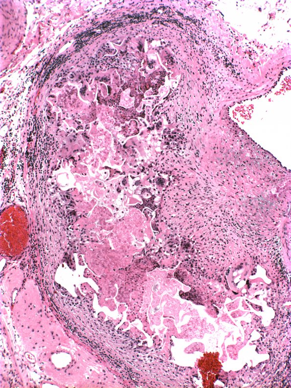 16A5 AVM embolized (Case 16) H&E 1