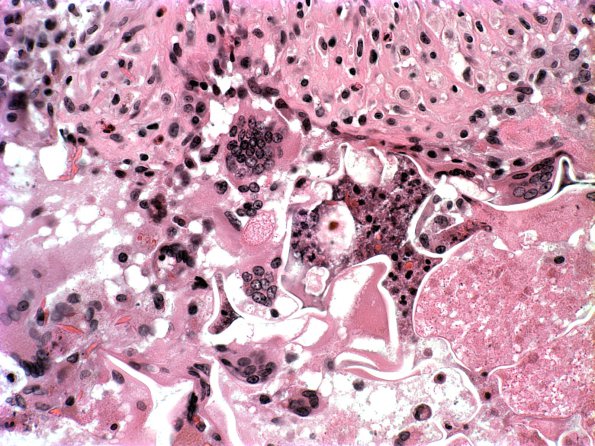 16A6 AVM embolized (Case 16) H&E 2