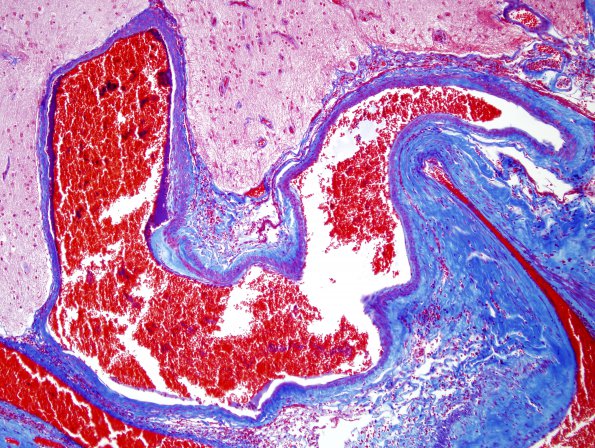 17B AVM (Case 17) Trichrome 1